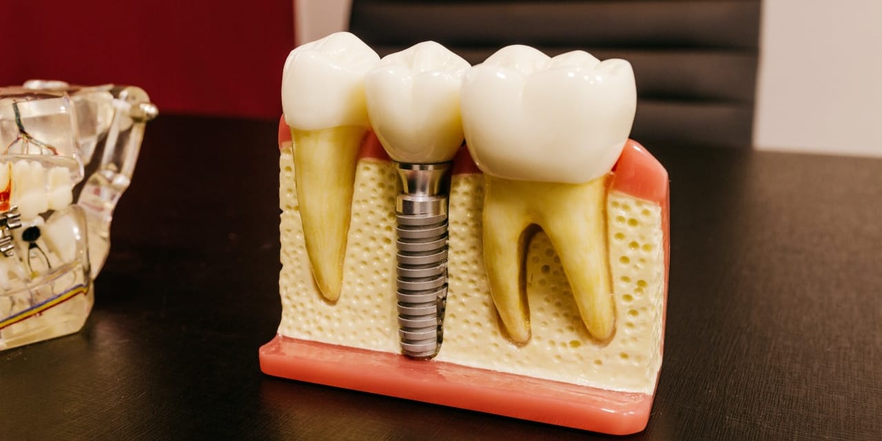 How to care for your dental implants