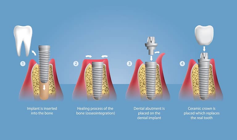 How dental implants works illustration