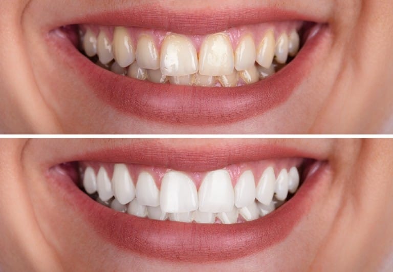 Teeth whitening illustration
